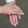 Dermatite : le magnétisme, une approche complémentaire pour apaiser la peau